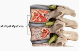 Multipel Myeloom – Ziekte van Kahler
